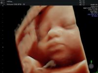 3D-Ultraschall in der Praxis