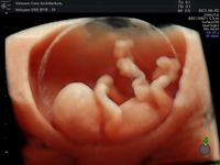 3D-Ultraschall in der Praxis